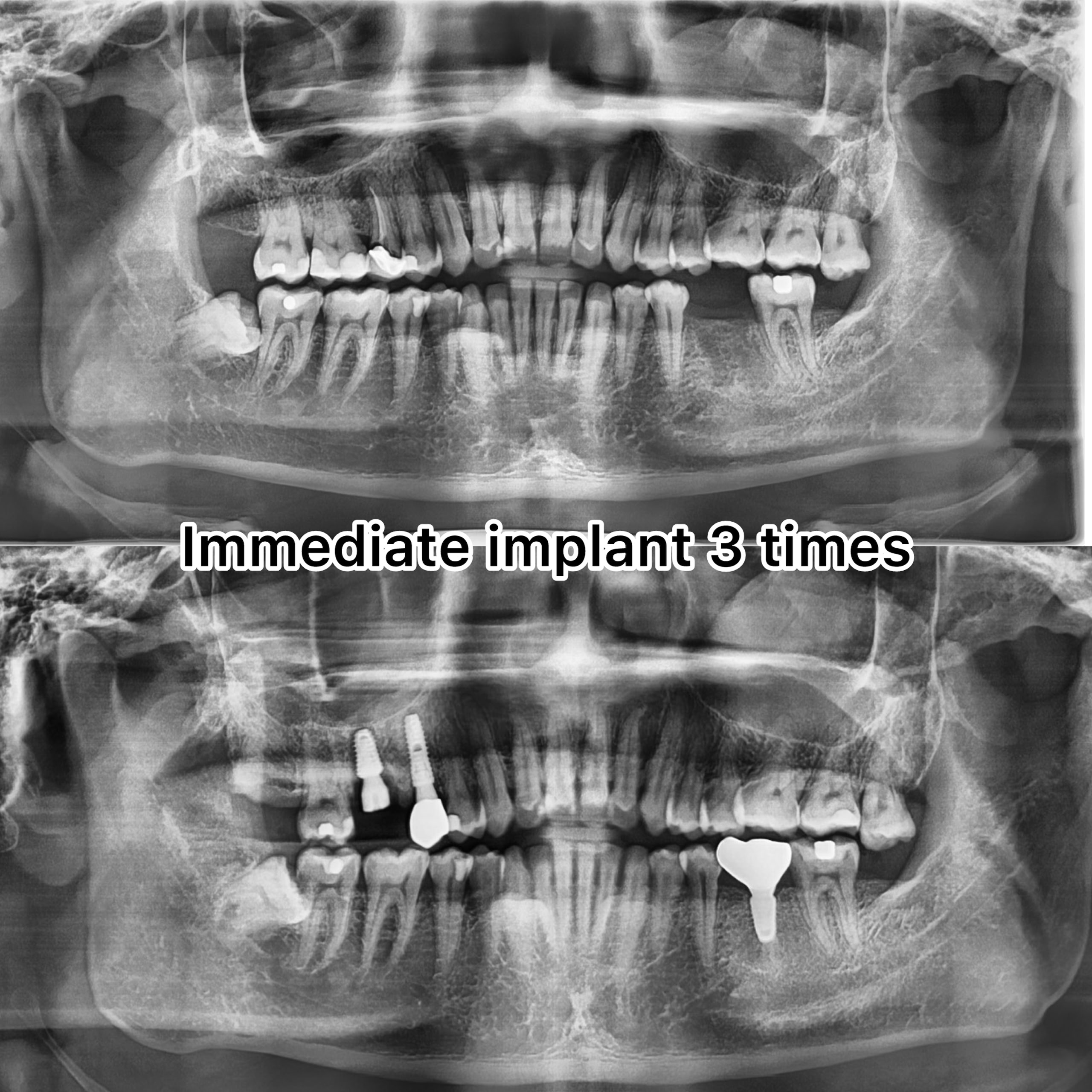 Three immediate dental implants case at LeSmile Dental Clinic Sri Petaling