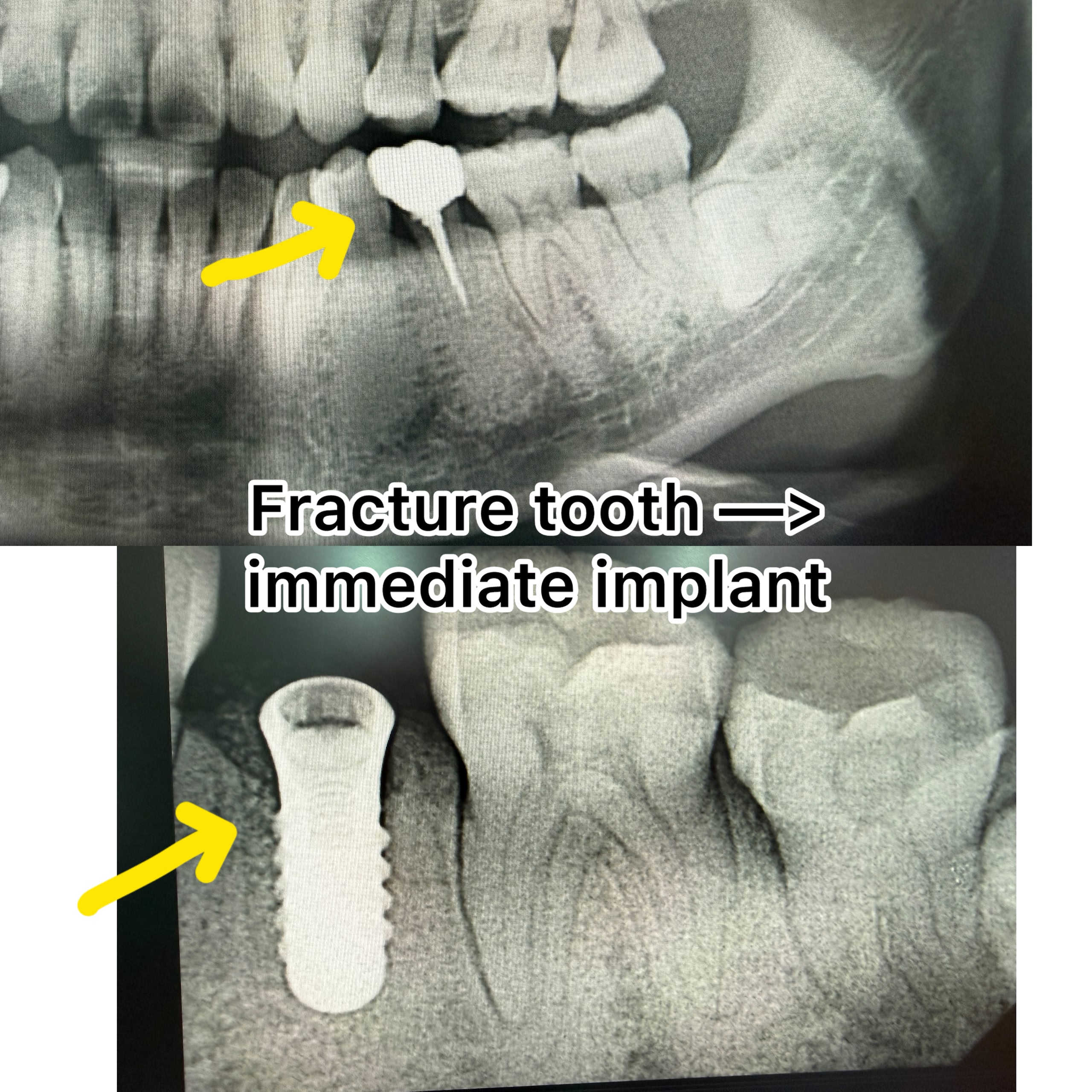 Immediate dental implant case at LeSmile Dental Clinic Sri Petaling