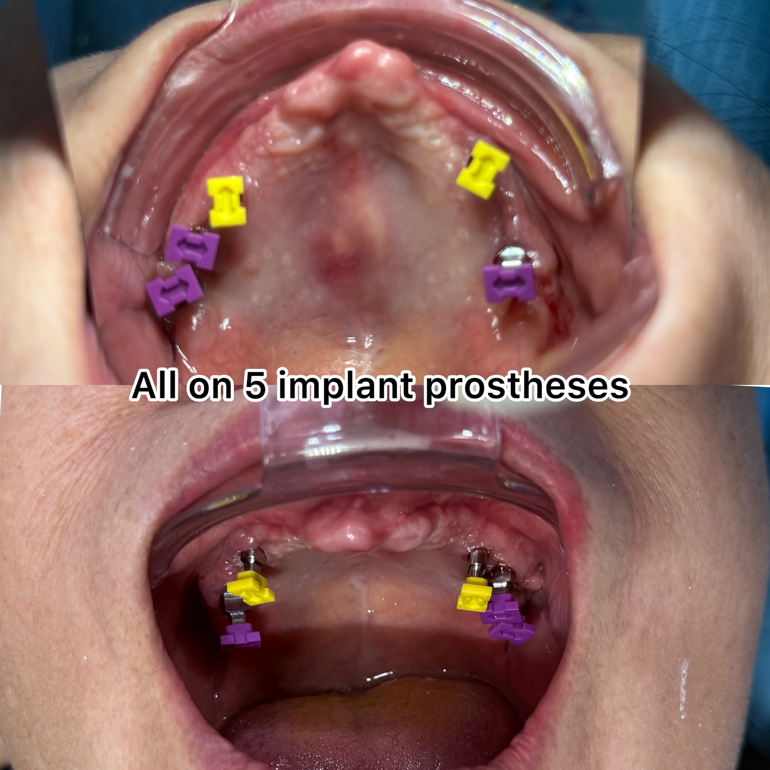 All-on-5 full arch dental implant case at LeSmile Dental Clinic Sri Petaling