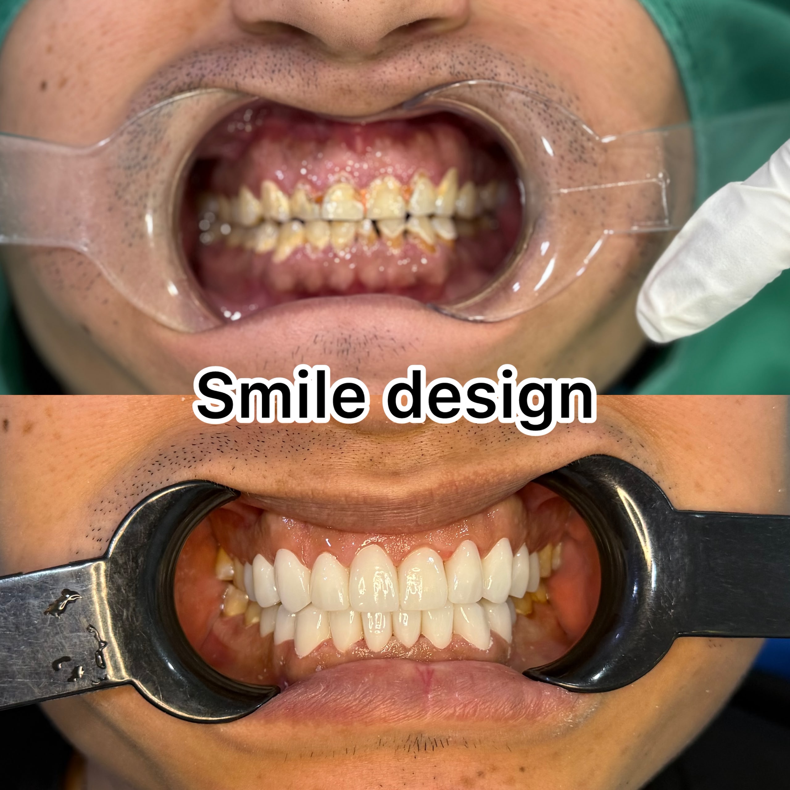 Before and after smile design at LeSmile Dental Clinic Sri Petaling, uneven and stained teeth restored to an even white smile
