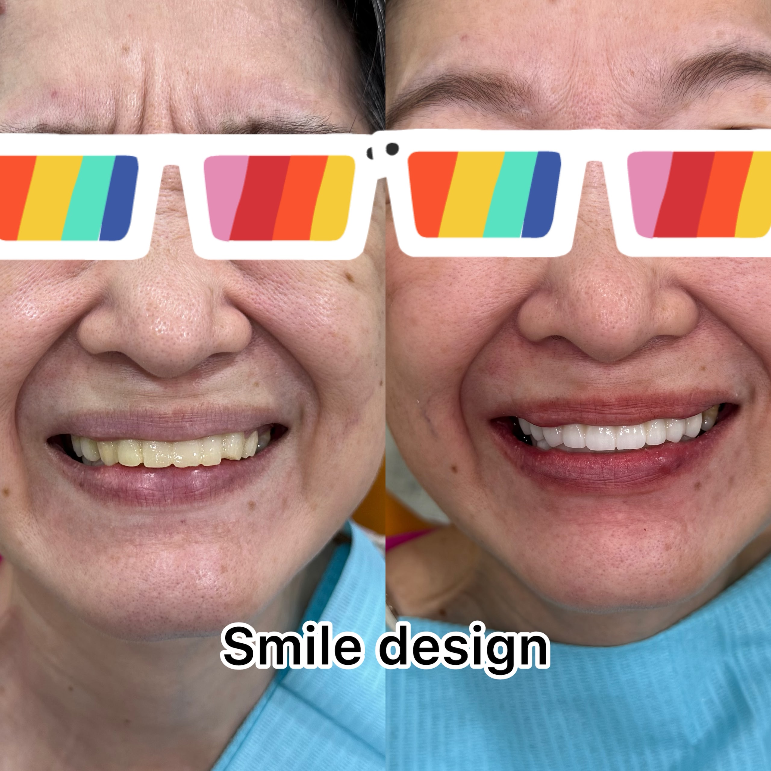 Before and after smile design at LeSmile Dental Clinic Sri Petaling, yellowed teeth changed to a brighter, natural-looking smile