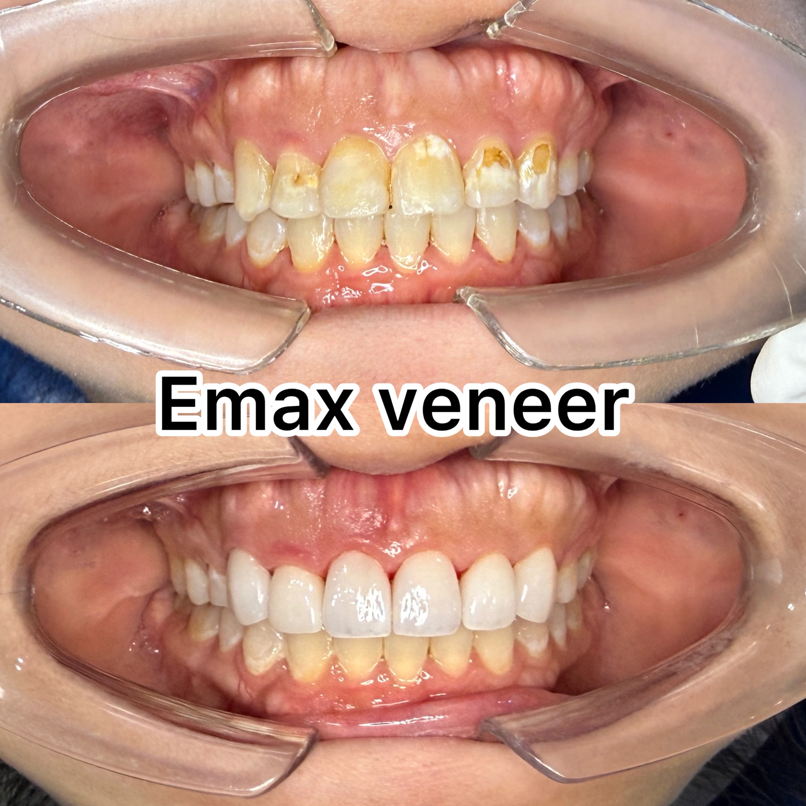 Before and after E.max veneers at LeSmile Dental Clinic Sri Petaling, stained upper front teeth restored with natural white veneers
