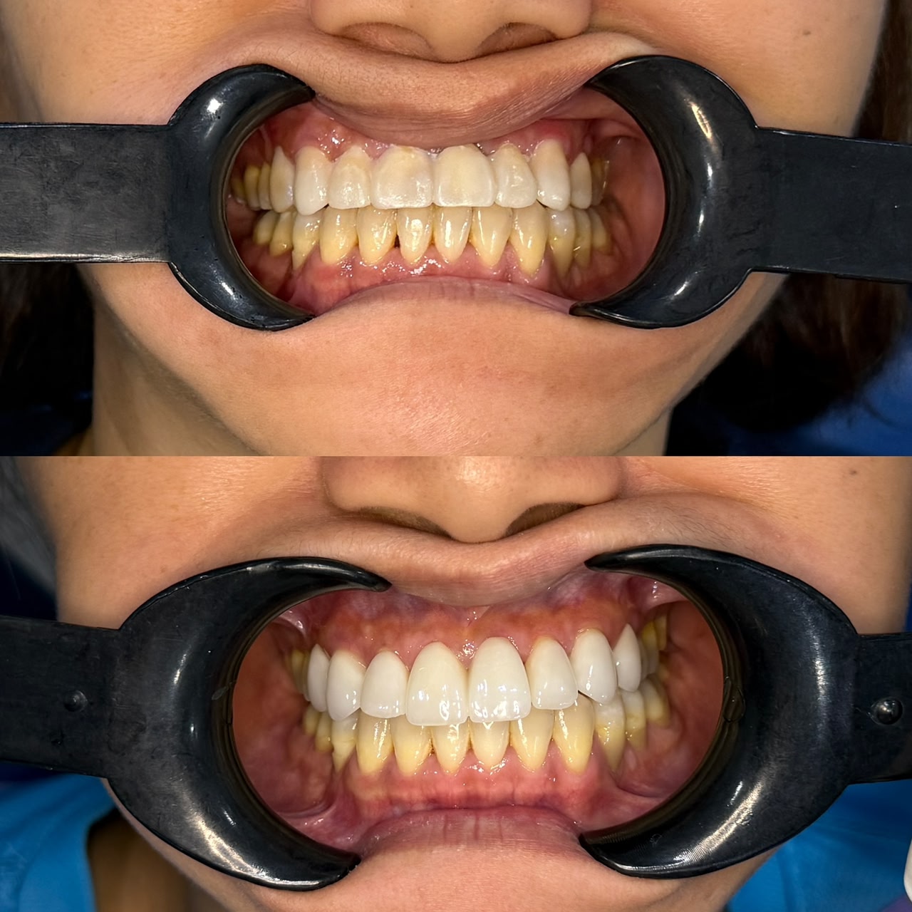 Before and after veneers at LeSmile Dental Clinic Sri Petaling, dull and uneven upper front teeth made brighter and more even