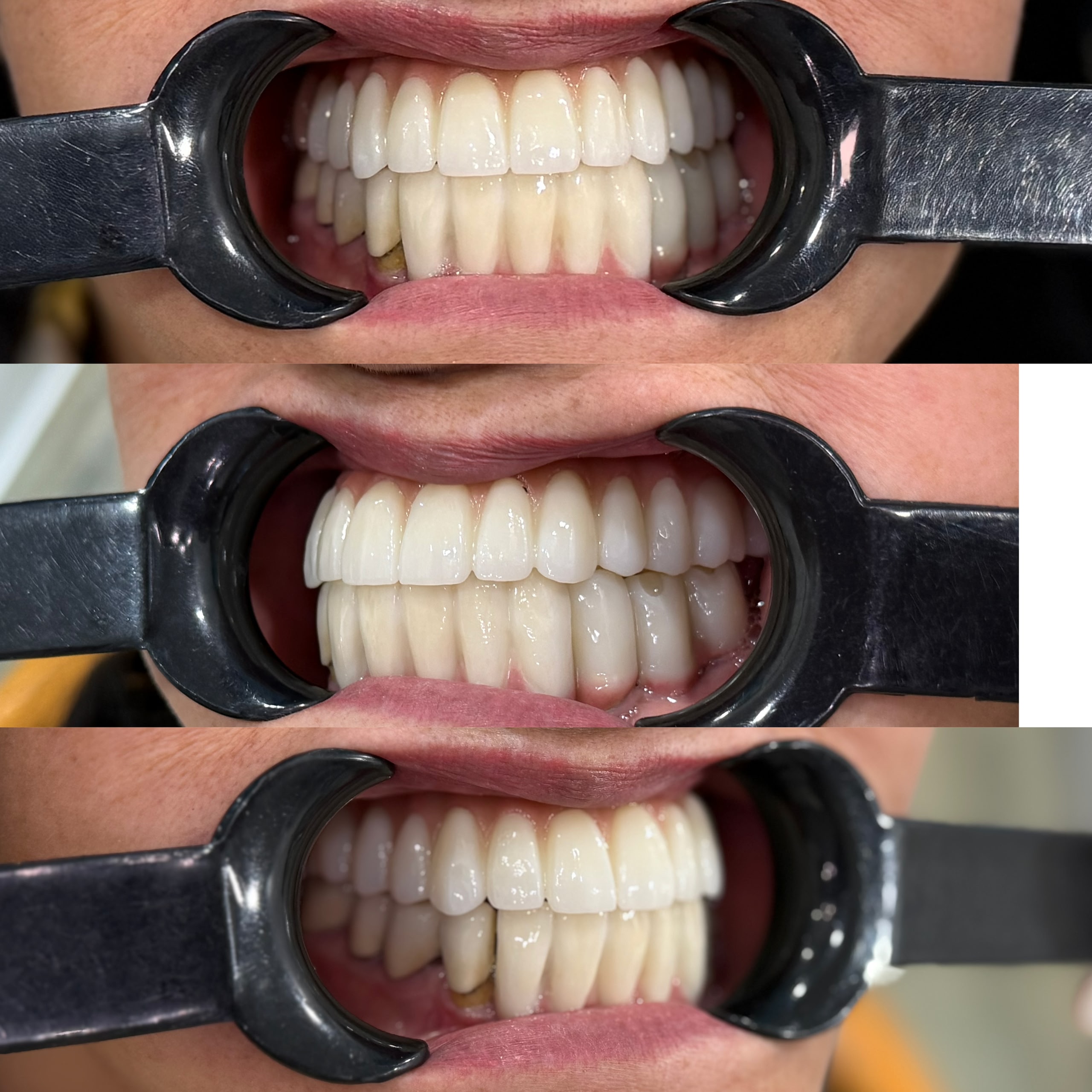 Finished E.max veneers at LeSmile Dental Clinic Sri Petaling, shown from the front and both sides